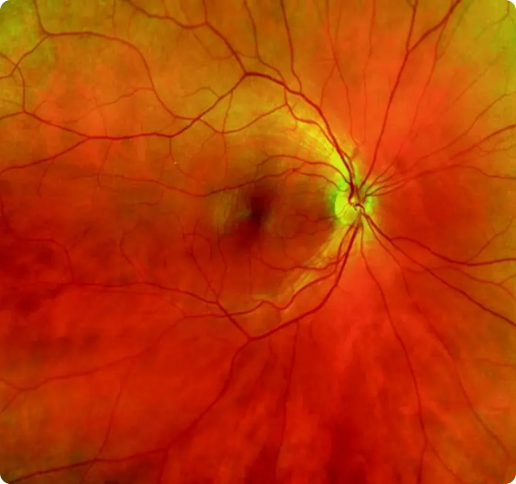 Detailed retinal image used during OCT evaluation