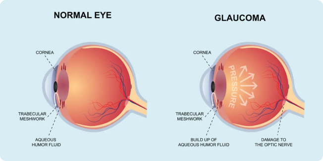 Diagram comparing a normal eye with an eye affected by glaucoma