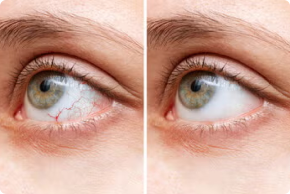 Comparison showing an irritated eye before and after treatment