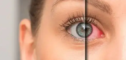 Dry Eye Treatment